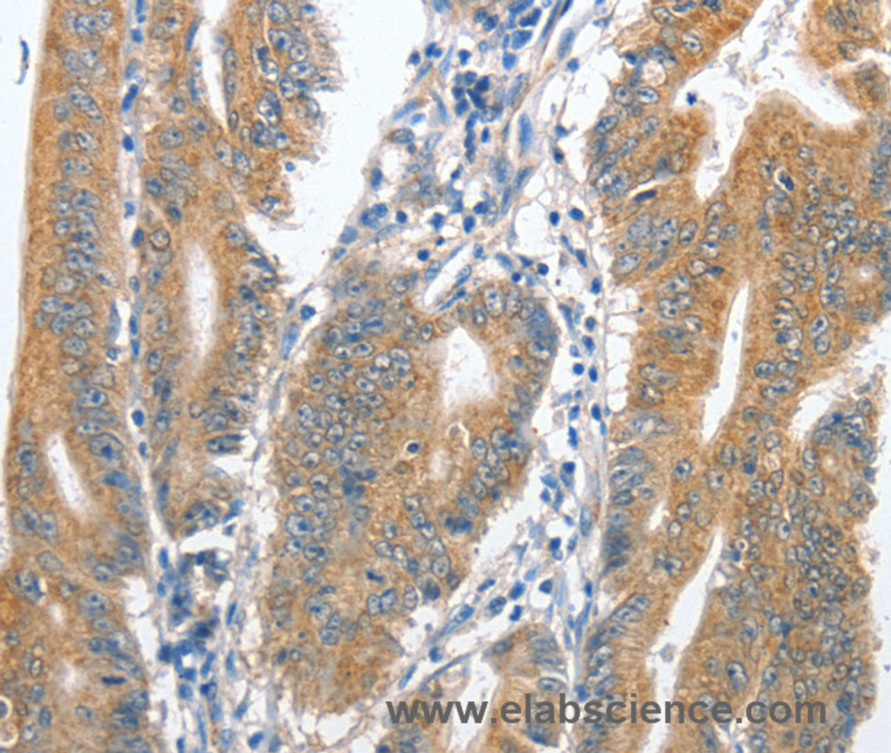 Immunohistochemistry of paraffin-embedded Human colon cancer tissue using CENPC Polyclonal Antibody at dilution 1:70