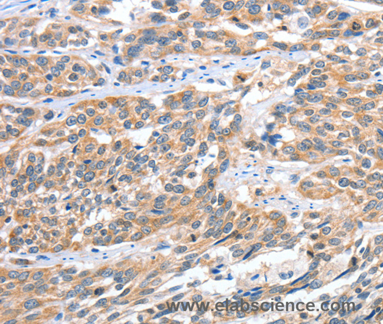 Immunohistochemistry of paraffin-embedded Human esophagus cancer tissue using CGB Polyclonal Antibody at dilution 1:60