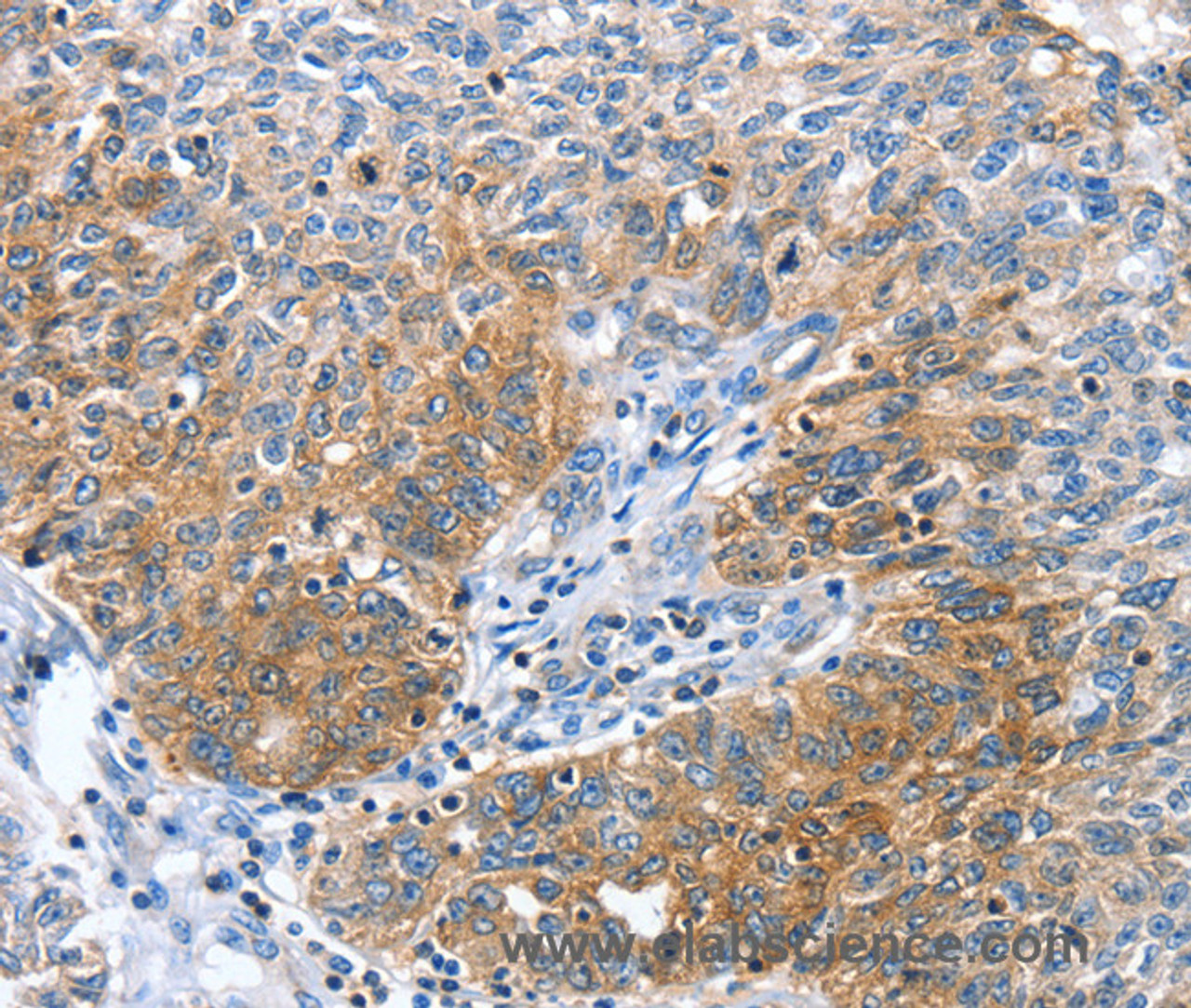 Immunohistochemistry of paraffin-embedded Human ovarian cancer tissue using CGB Polyclonal Antibody at dilution 1:60