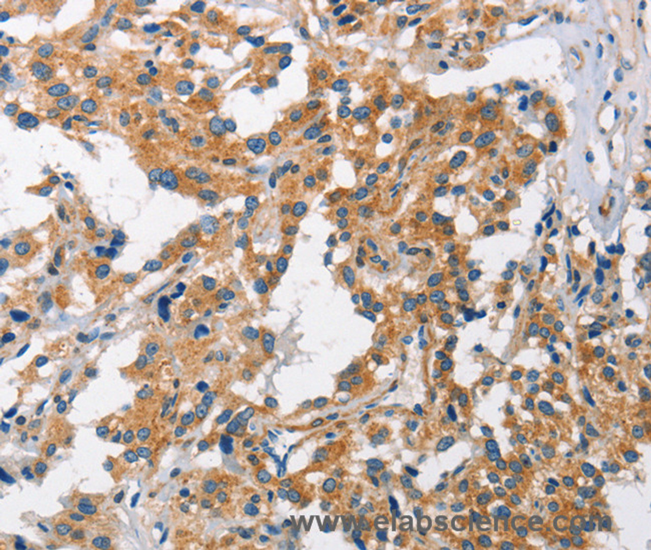 Immunohistochemistry of paraffin-embedded Human thyroid cancer tissue using CHMP1A Polyclonal Antibody at dilution 1:60