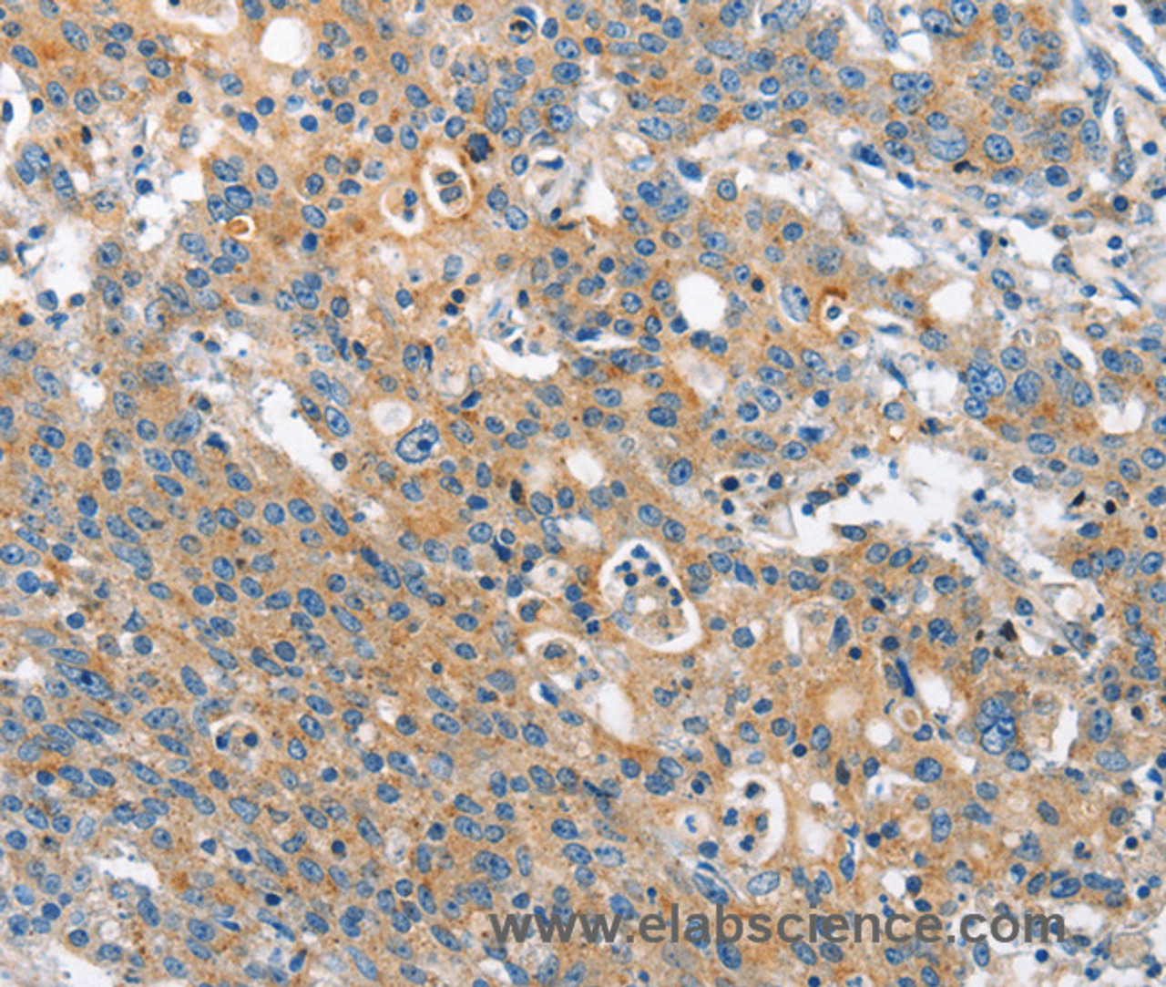 Immunohistochemistry of paraffin-embedded Human gastric cancer tissue using CHMP1A Polyclonal Antibody at dilution 1:60