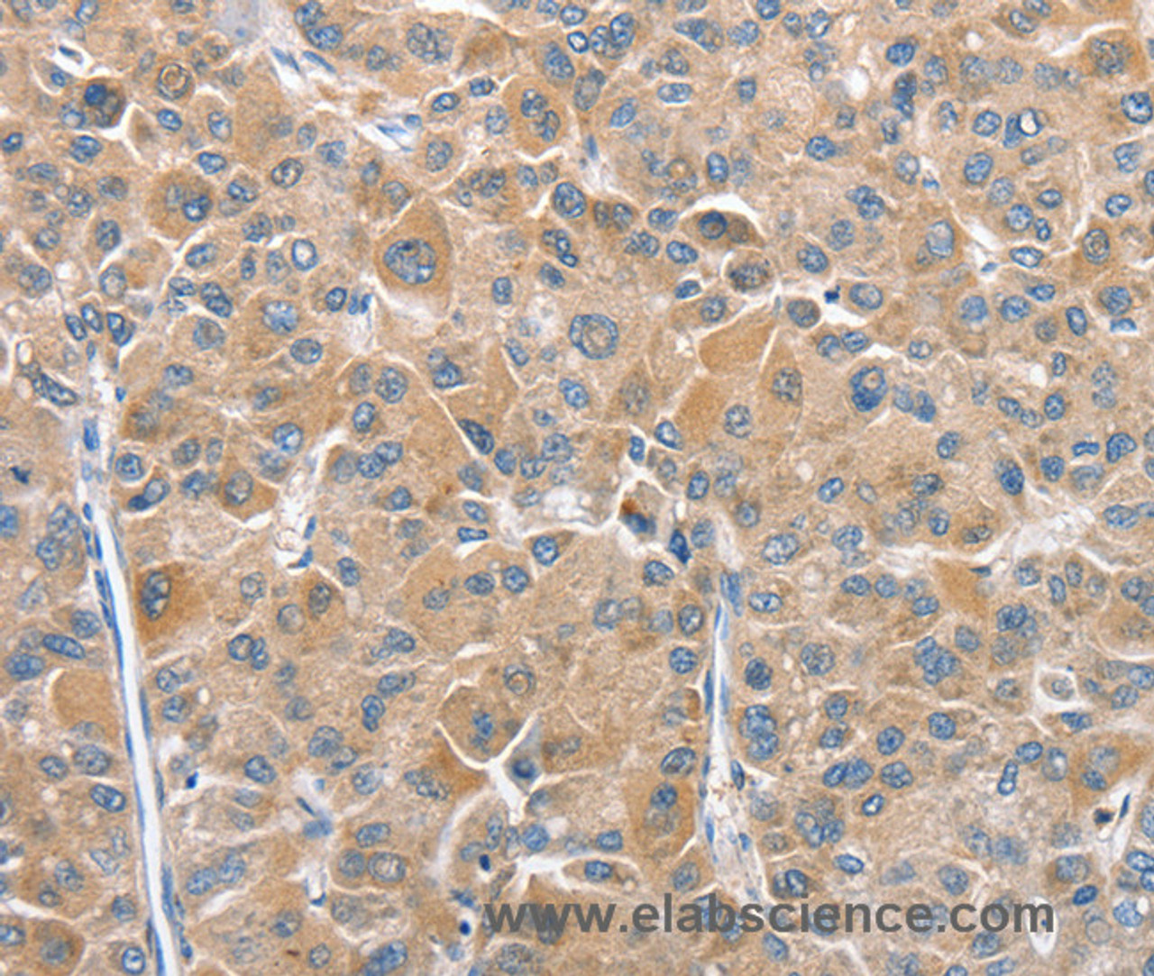 Immunohistochemistry of paraffin-embedded Human liver cancer tissue using CHMP4B Polyclonal Antibody at dilution 1:40