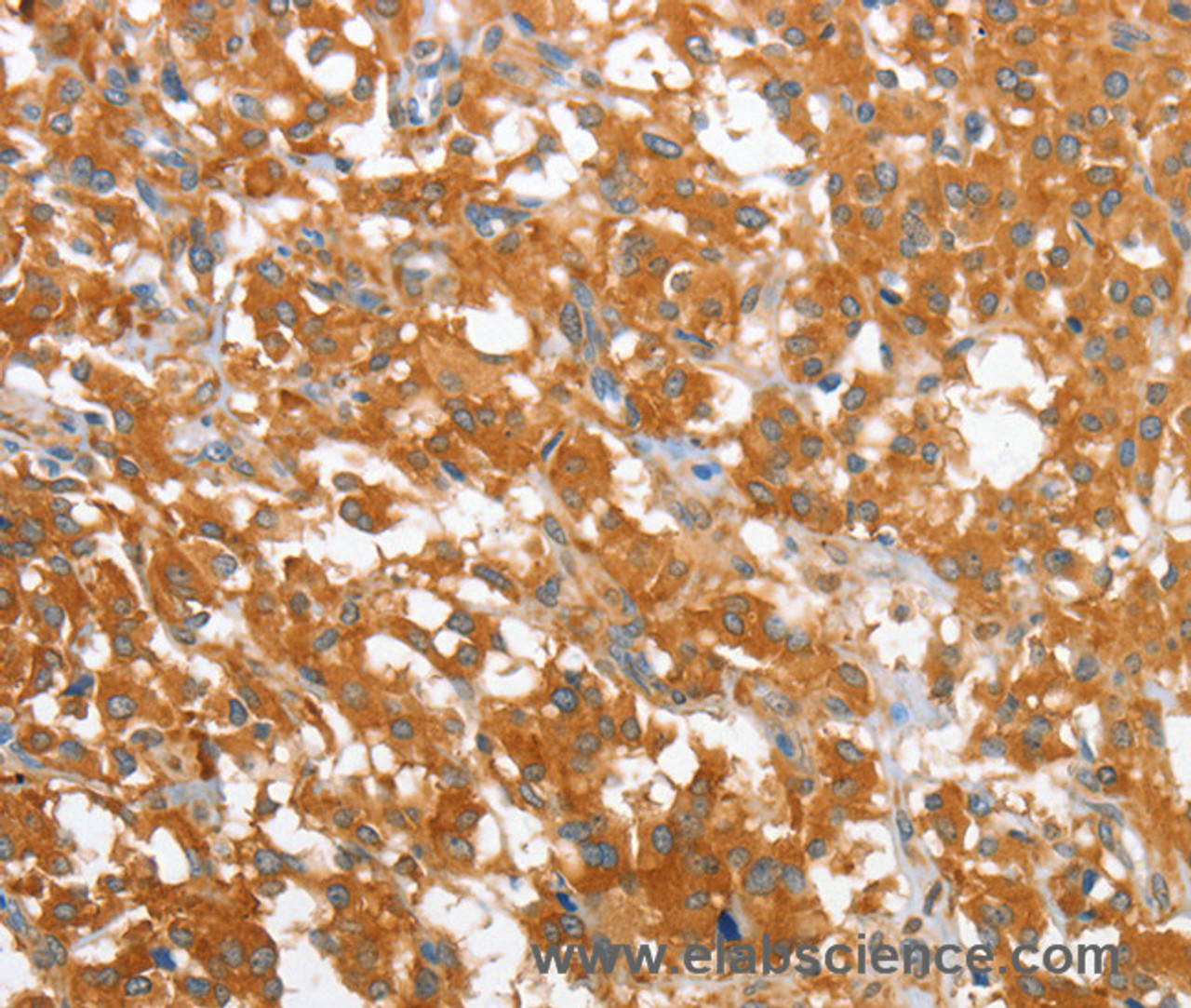 Immunohistochemistry of paraffin-embedded Human thyroid cancer using WNT3A Polyclonal Antibody at dilution of 1:40