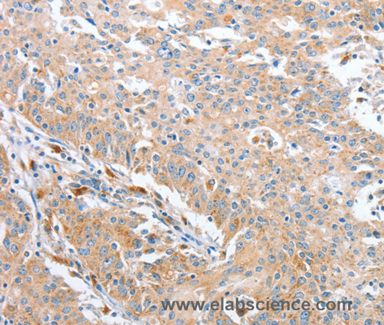 Immunohistochemistry of paraffin-embedded Human gastric cancer using WNT3A Polyclonal Antibody at dilution of 1:40