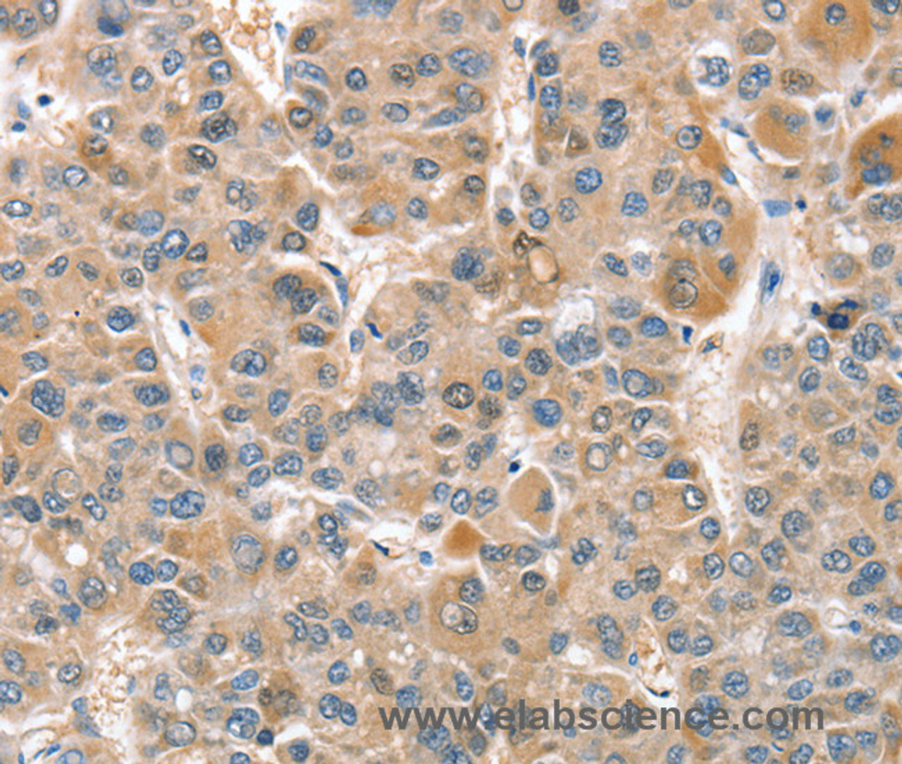 Immunohistochemistry of paraffin-embedded Human liver cancer tissue using CIAPIN1 Polyclonal Antibody at dilution 1:60