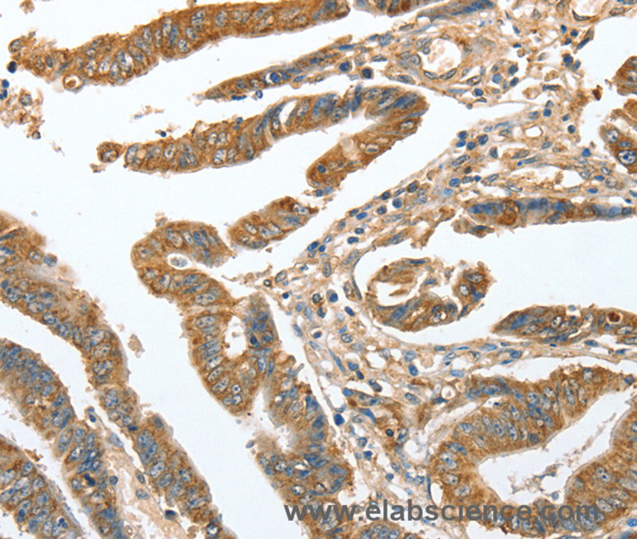 Immunohistochemistry of paraffin-embedded Human colon cancer tissue using CKAP2 Polyclonal Antibody at dilution 1:70