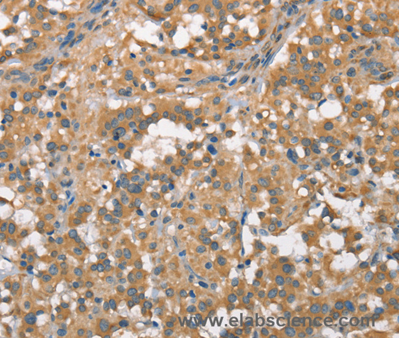 Immunohistochemistry of paraffin-embedded Human thyroid cancer using PLEKHO1 Polyclonal Antibody at dilution of 1:70