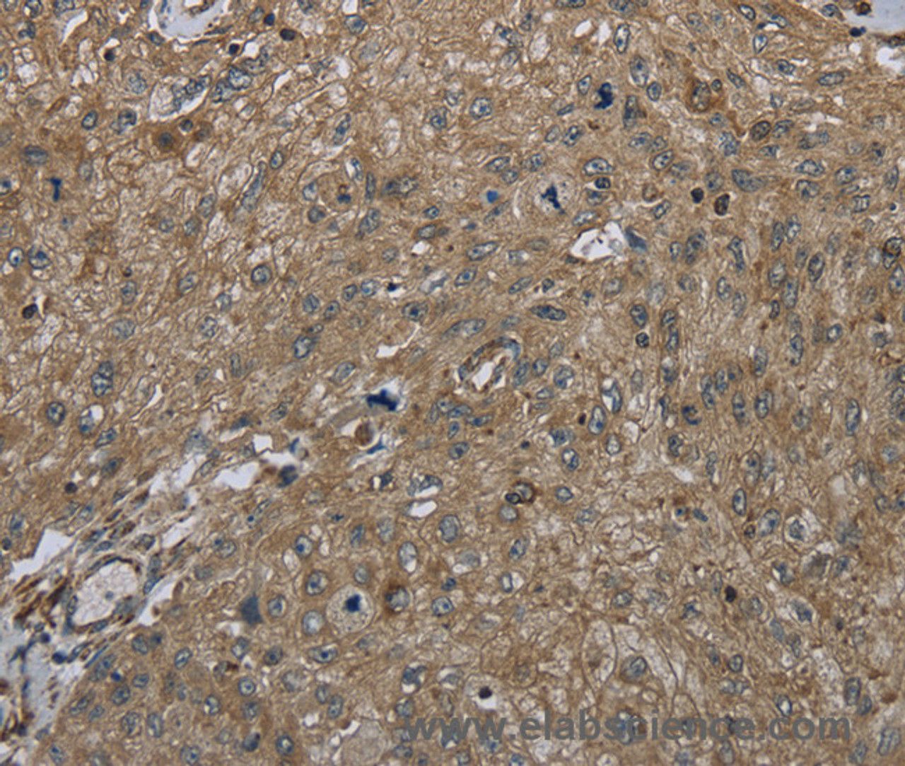 Immunohistochemistry of paraffin-embedded Human esophagus cancer tissue using CLPS Polyclonal Antibody at dilution 1:45