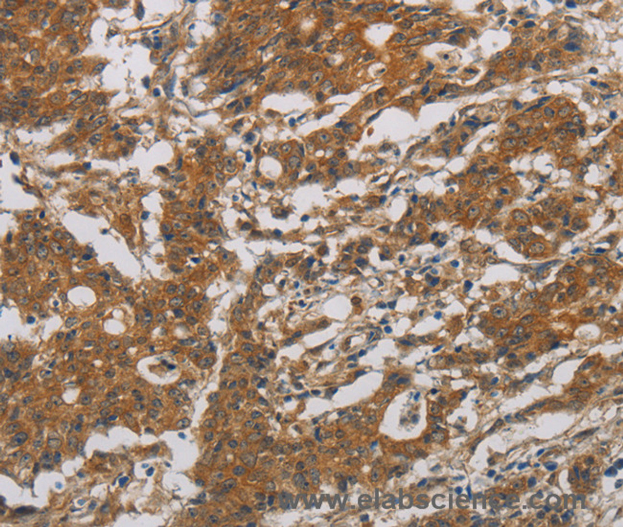 Immunohistochemistry of paraffin-embedded Human gastic cancer using CNDP1 Polyclonal Antibody at dilution of 1:30