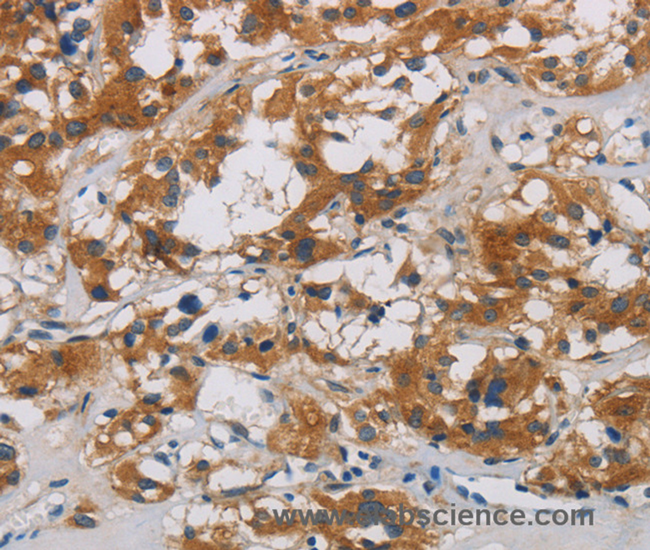 Immunohistochemistry of paraffin-embedded Human thyroid cancer using CNDP1 Polyclonal Antibody at dilution of 1:30