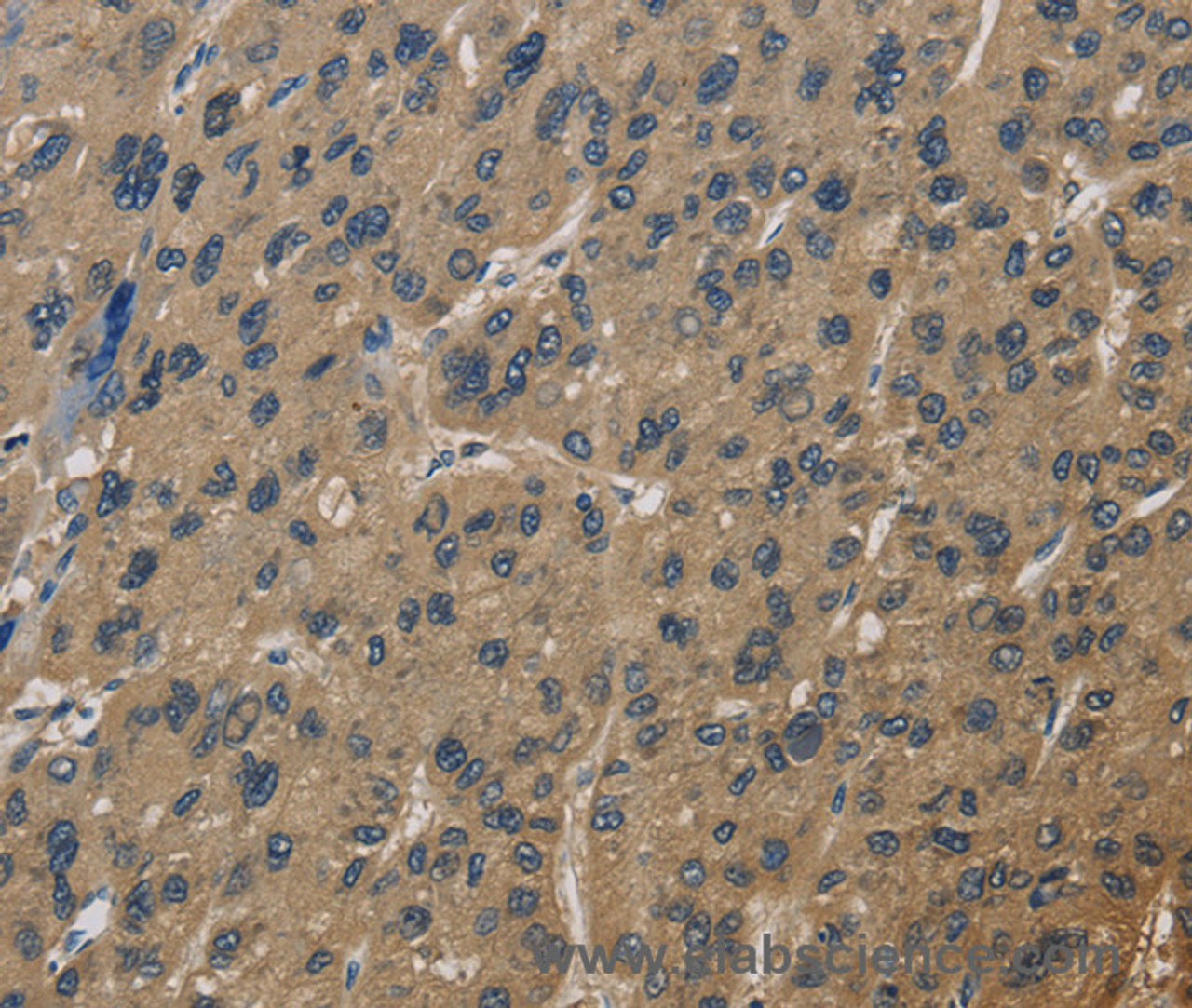 Immunohistochemistry of paraffin-embedded Human liver cancer using CORO1C Polyclonal Antibody at dilution of 1:60