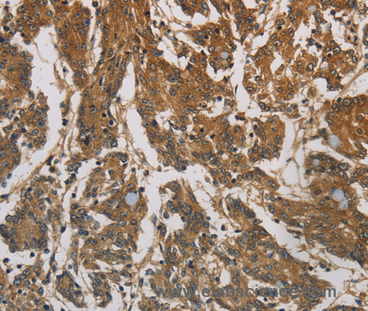 Immunohistochemistry of paraffin-embedded Human colon cancer using CORO1C Polyclonal Antibody at dilution of 1:60