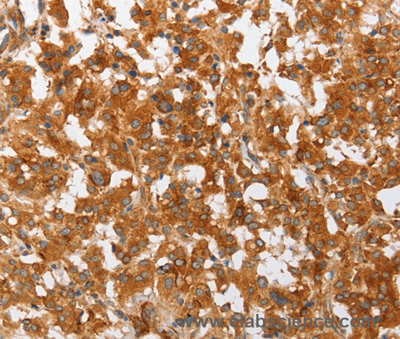 Immunohistochemistry of paraffin-embedded Human thyroid cancer using cPLA2 Polyclonal Antibody at dilution of 1:50
