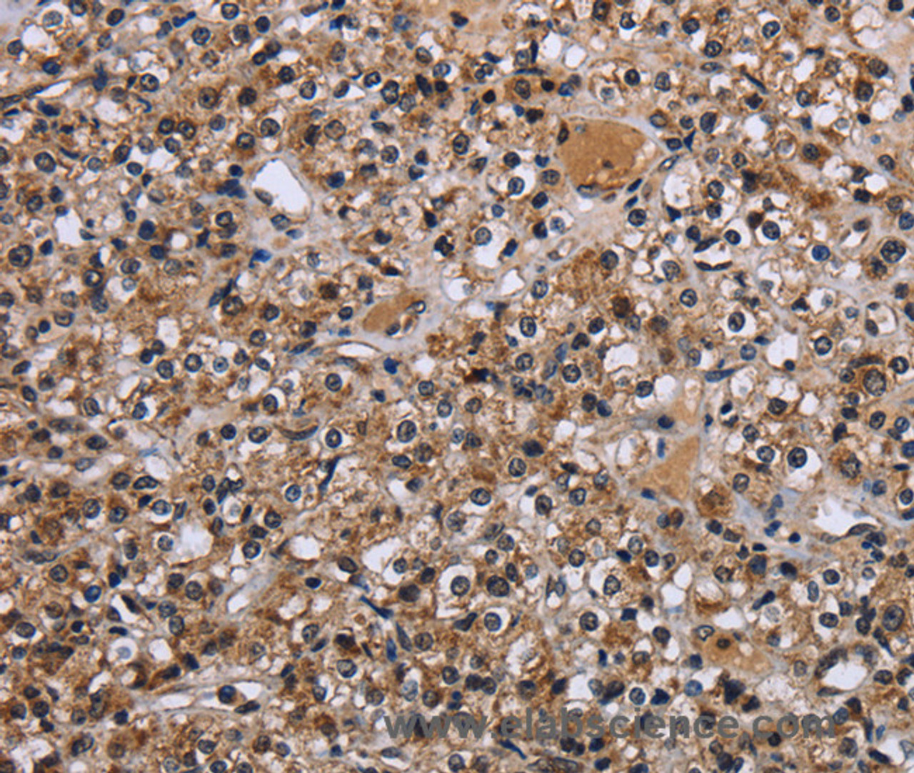 Immunohistochemistry of paraffin-embedded Human prostate cancer using c-Rel Polyclonal Antibody at dilution of 1:30