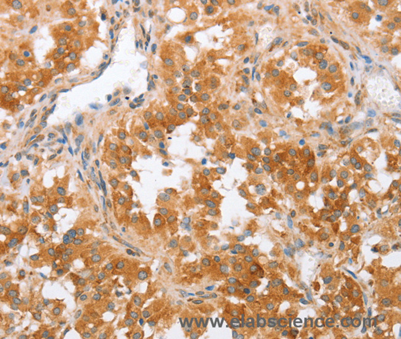 Immunohistochemistry of paraffin-embedded Human thyroid cancer using CRELD2 Polyclonal Antibody at dilution of 1:50