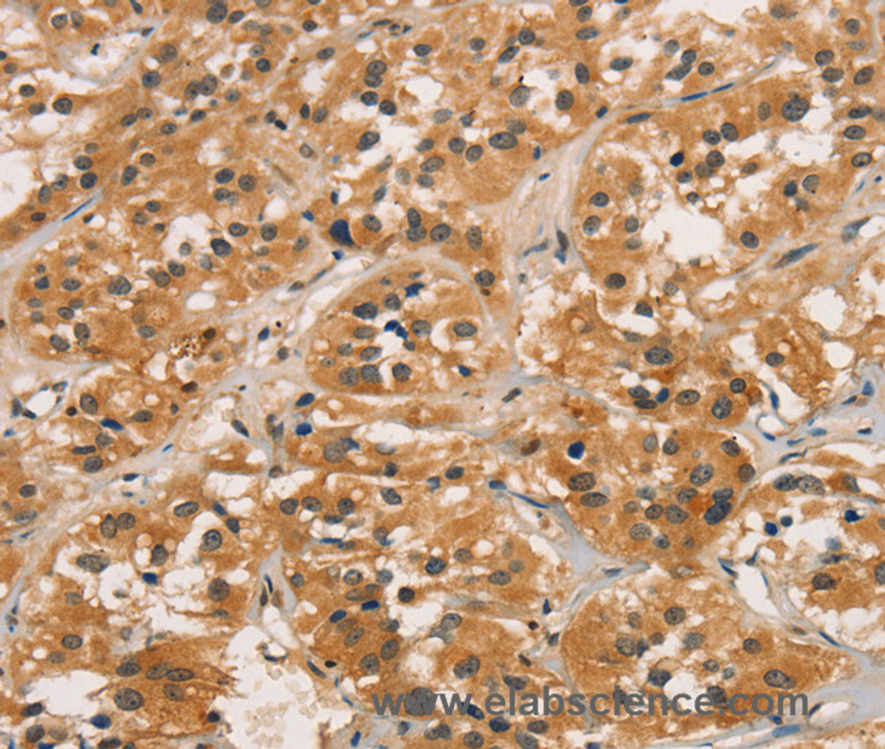 Immunohistochemistry of paraffin-embedded Human thyroid cancer tissue using CTNNBIP1 Polyclonal Antibody at dilution 1:30