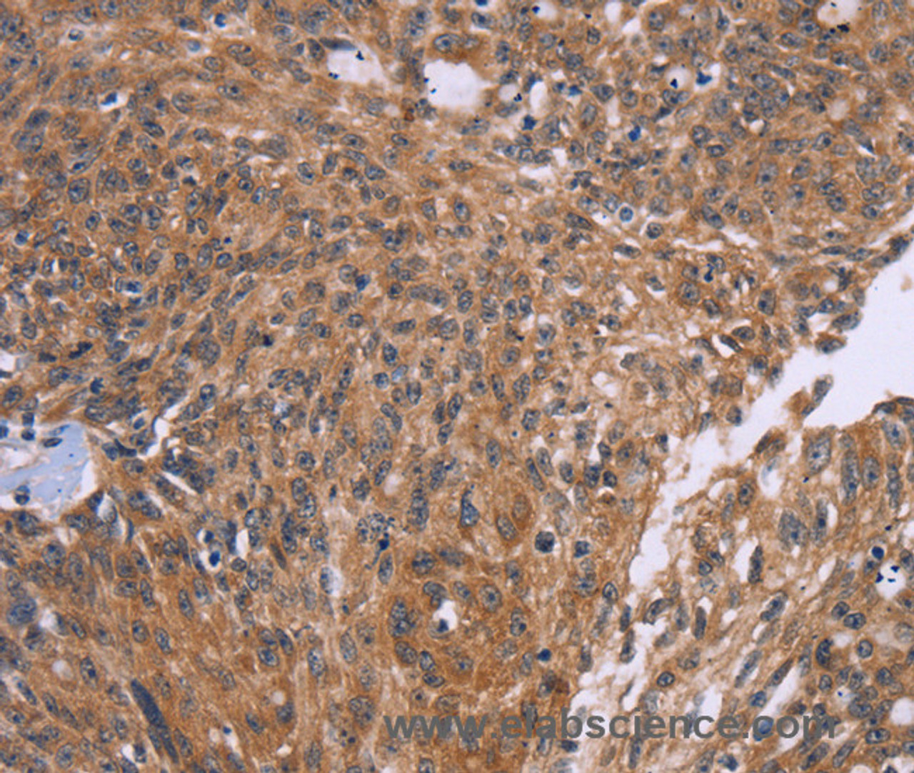 Immunohistochemistry of paraffin-embedded Human ovarian cancer tissue using CTNNBL1 Polyclonal Antibody at dilution 1:50