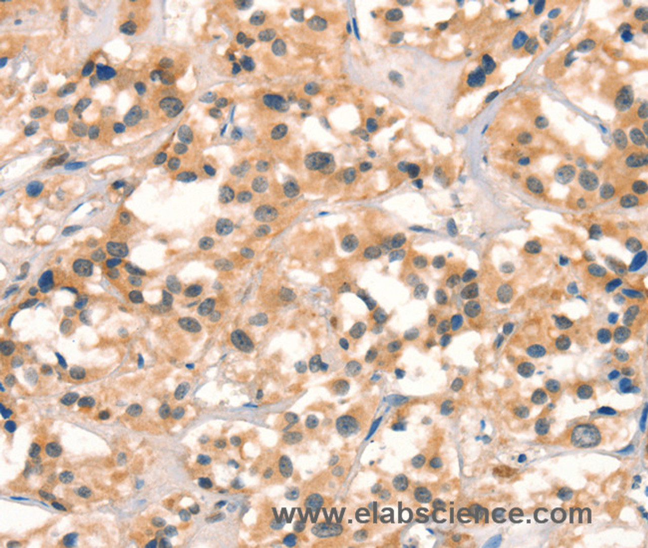 Immunohistochemistry of paraffin-embedded Human thyroid cancer tissue using CUEDC2 Polyclonal Antibody at dilution 1:30