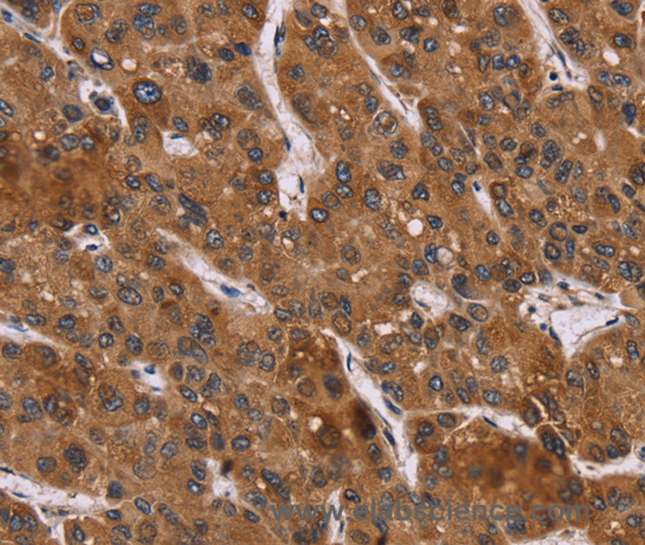 Immunohistochemistry of paraffin-embedded Human liver cancer using PPIB Polyclonal Antibody at dilution of 1:45