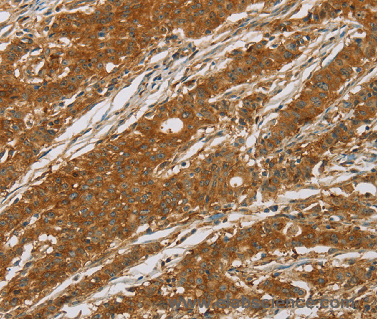 Immunohistochemistry of paraffin-embedded Human gasrtic cancer tissue using CYP27A1 Polyclonal Antibody at dilution 1:50
