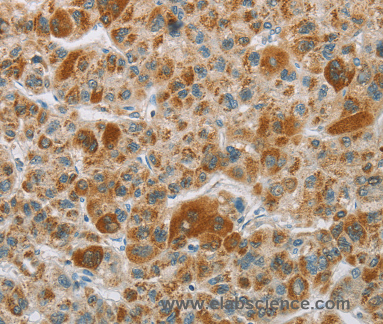 Immunohistochemistry of paraffin-embedded Human liver cancer tissue using CYP27A1 Polyclonal Antibody at dilution 1:50