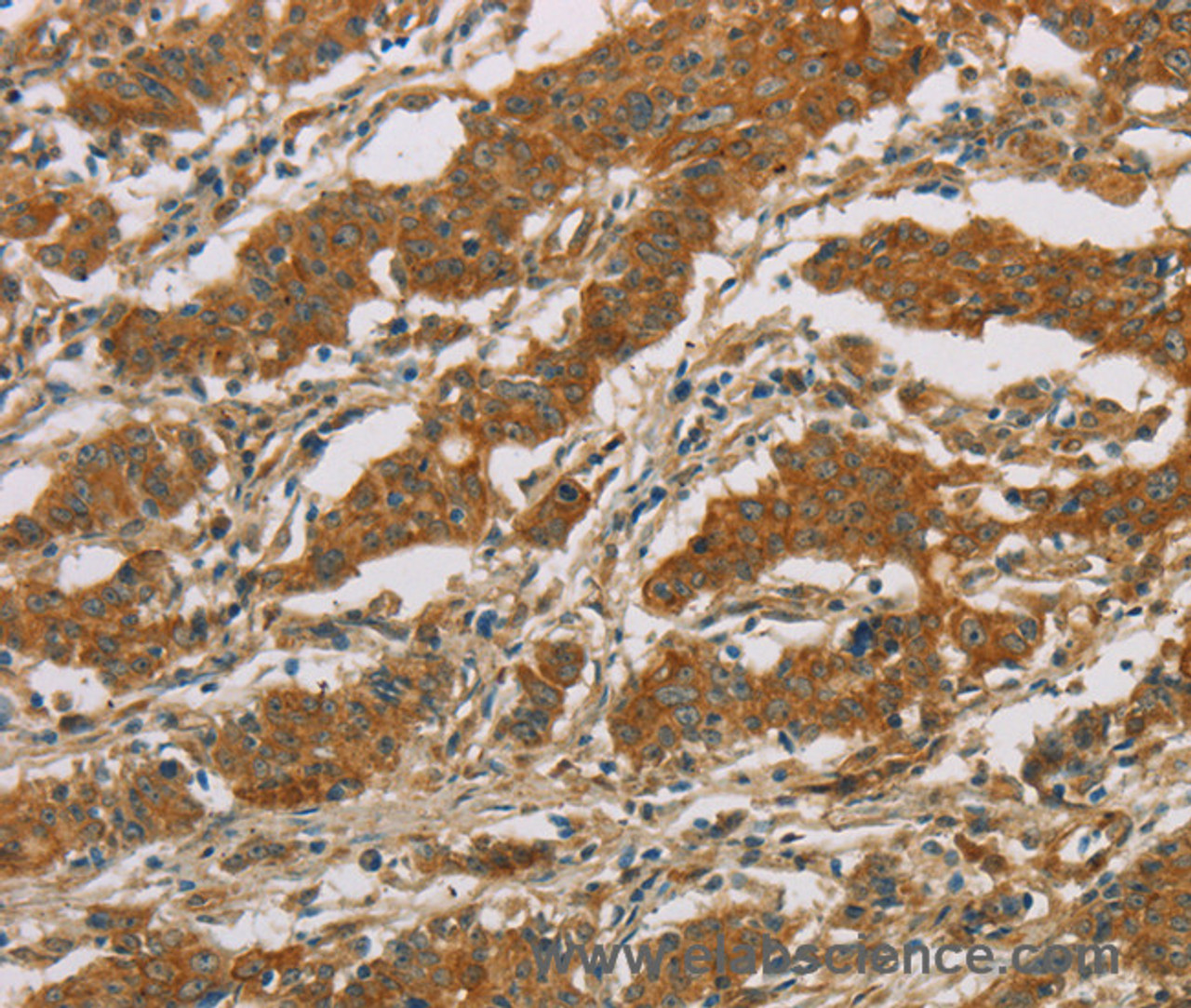Immunohistochemistry of paraffin-embedded Human gasrtic cancer tissue using CYP39A1 Polyclonal Antibody at dilution 1:50