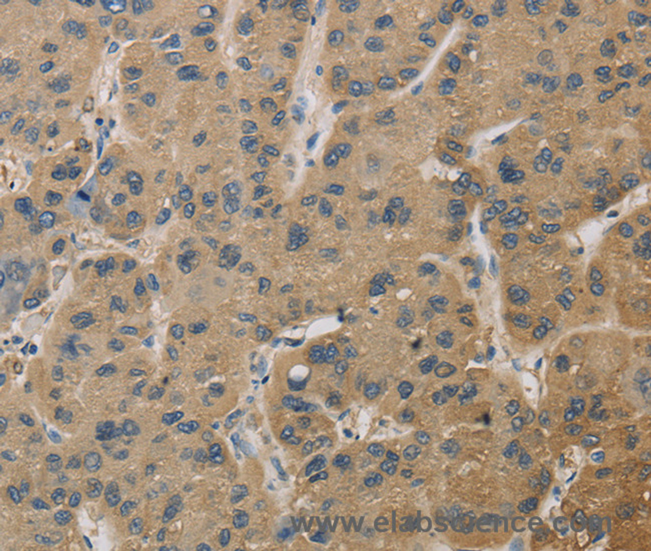 Immunohistochemistry of paraffin-embedded Human liver cancer tissue using TBXAS1 Polyclonal Antibody at dilution 1:30