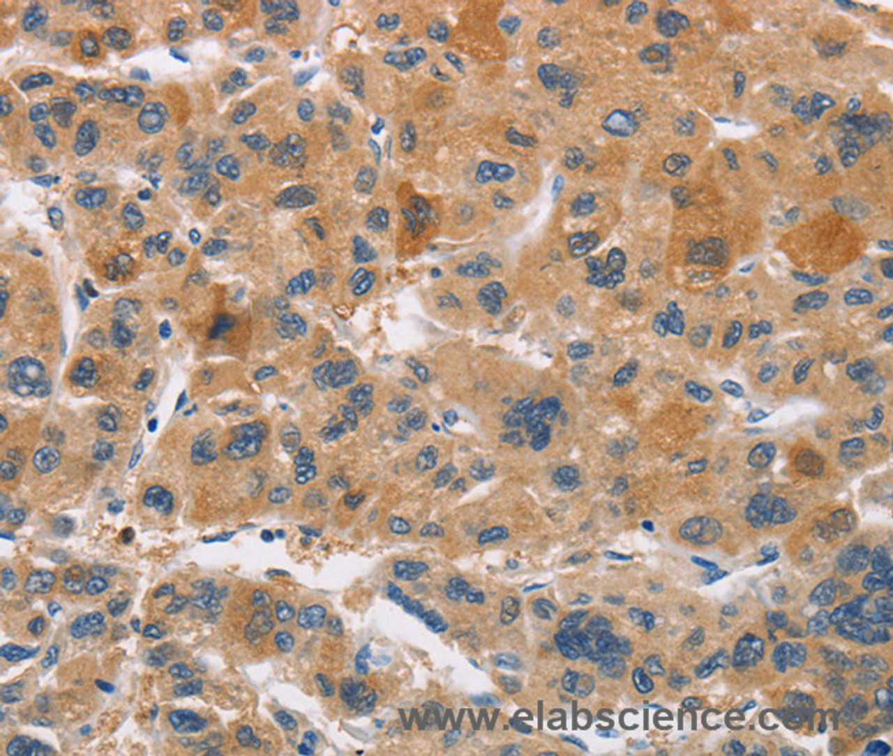 Immunohistochemistry of paraffin-embedded Human liver cancer using CYP4A11 Polyclonal Antibody at dilution of 1:30