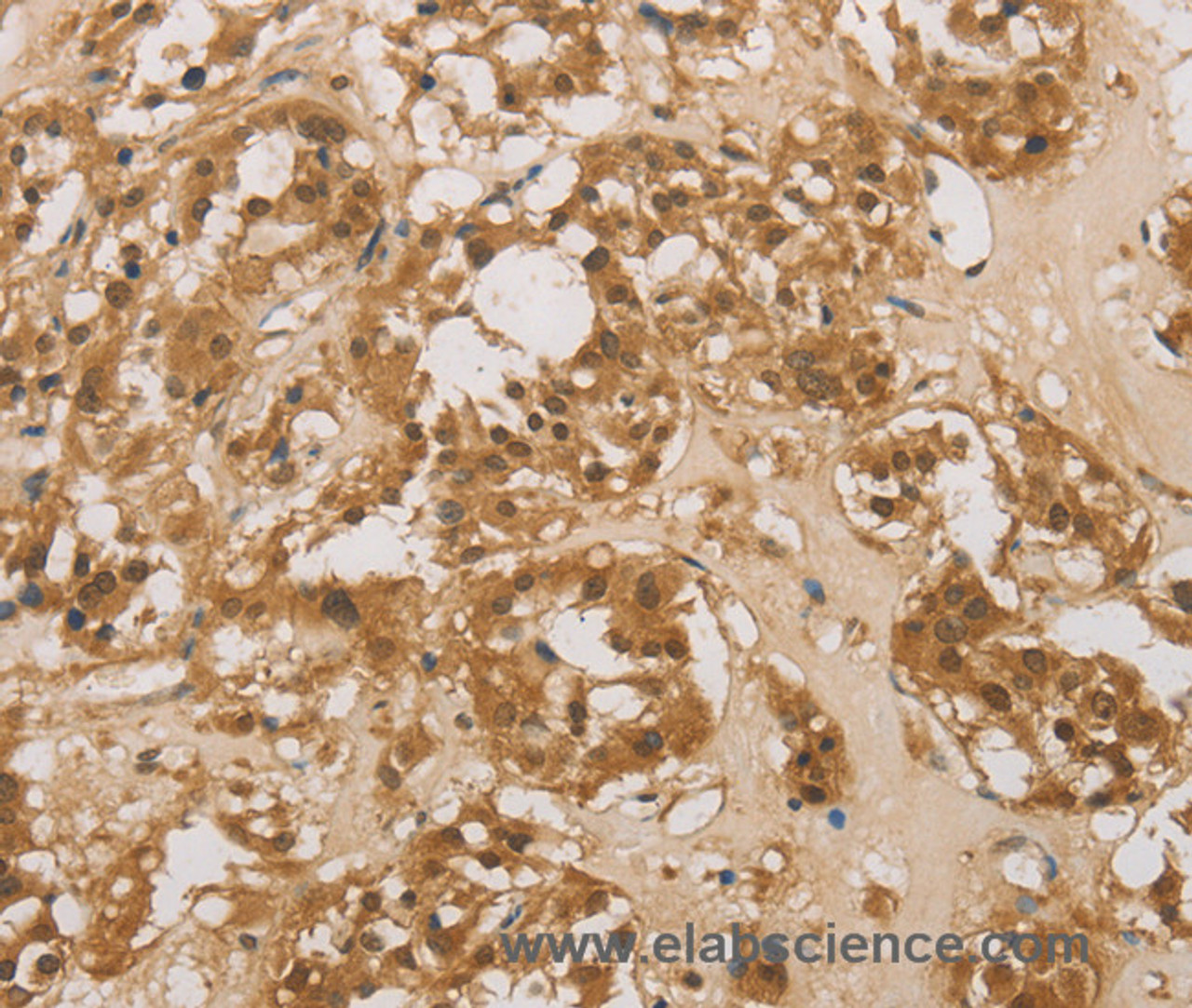 Immunohistochemistry of paraffin-embedded Human thyroid cancer tissue using DACH1 Polyclonal Antibody at dilution 1:50