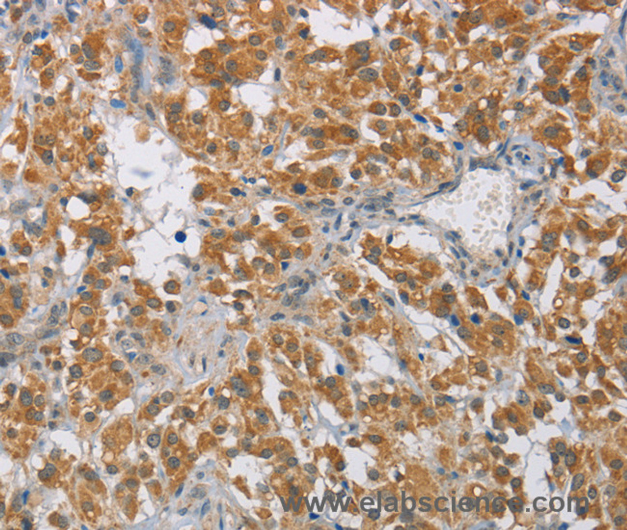 Immunohistochemistry of paraffin-embedded Human thyroid cancer tissue using DIO1 Polyclonal Antibody at dilution 1:60