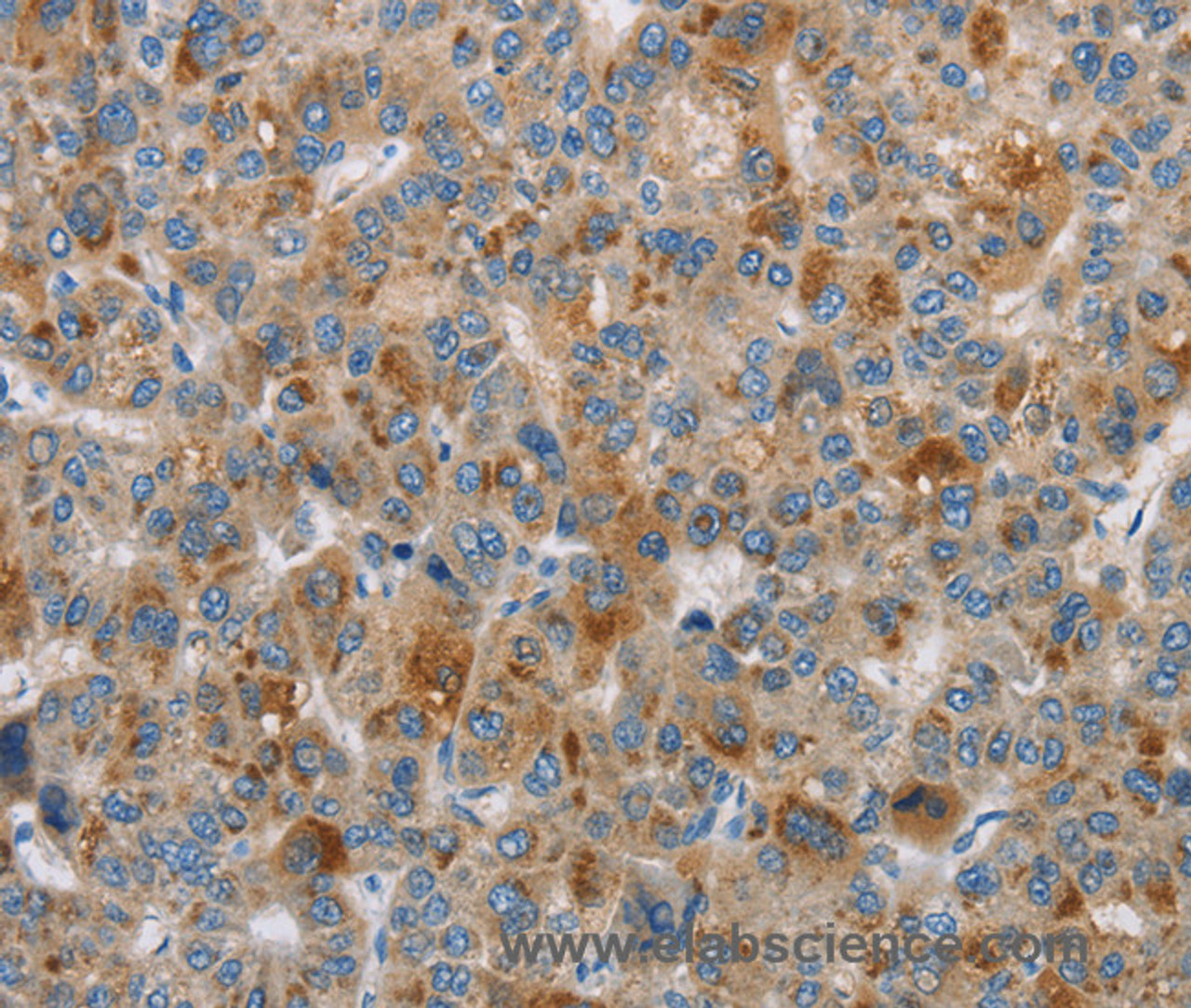 Immunohistochemistry of paraffin-embedded Human liver cancer using DBH Polyclonal Antibody at dilution of 1:70
