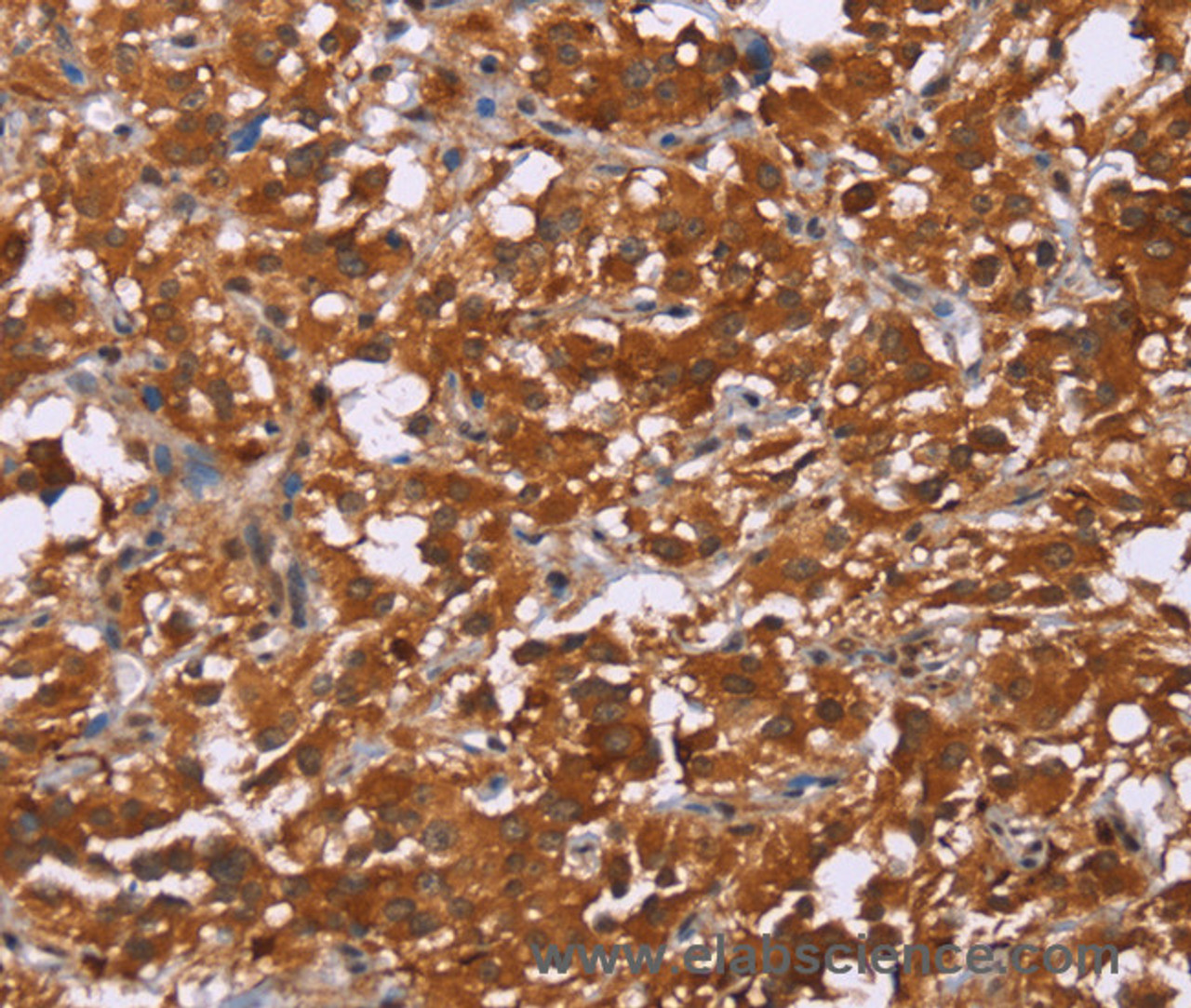 Immunohistochemistry of paraffin-embedded Human thyroid cancer tissue using DCBLD2 Polyclonal Antibody at dilution 1:50