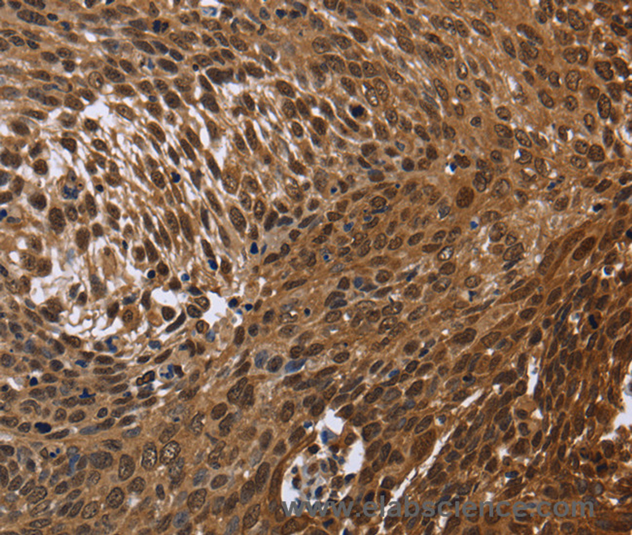 Immunohistochemistry of paraffin-embedded Human cervical cancer tissue using DCP1A Polyclonal Antibody at dilution 1:50