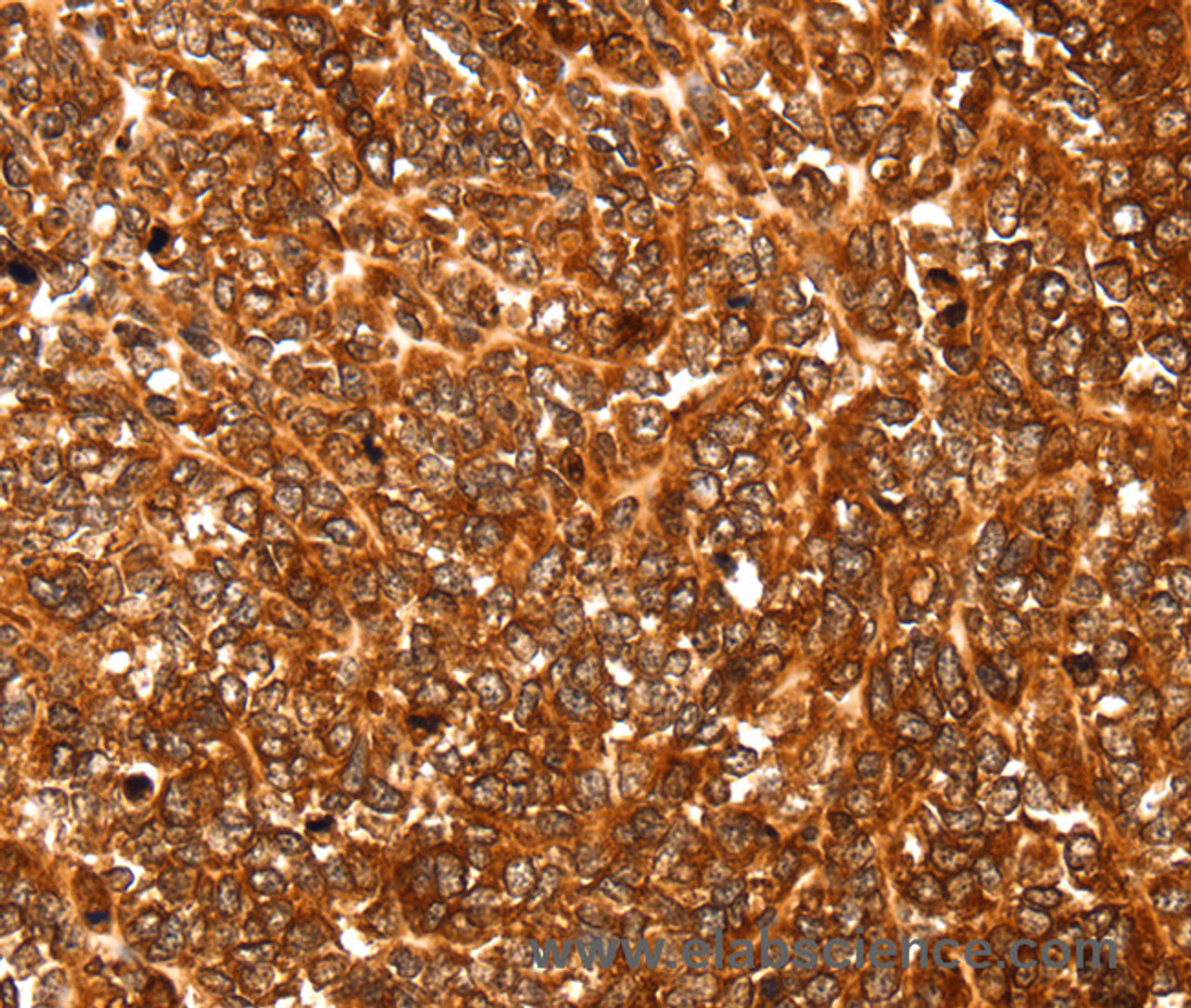 Immunohistochemistry of paraffin-embedded Human ovarian cancer using ALDOA Polyclonal Antibody at dilution of 1:30