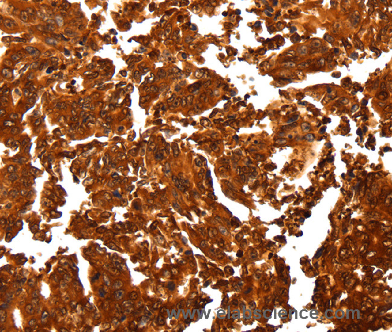 Immunohistochemistry of paraffin-embedded Human gastic cancer using ALDOA Polyclonal Antibody at dilution of 1:30