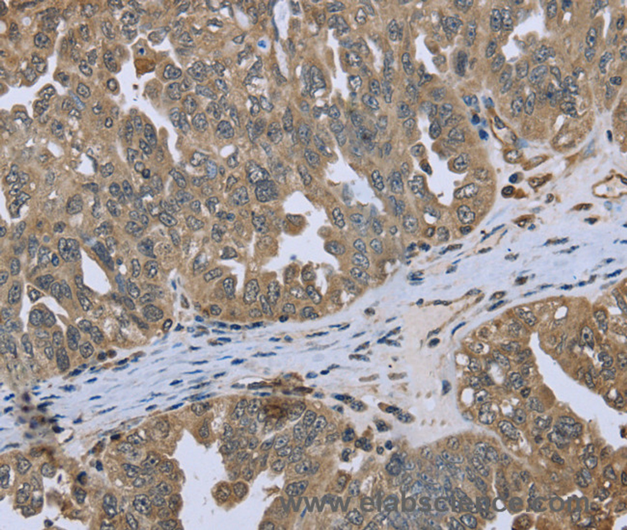 Immunohistochemistry of paraffin-embedded Human ovarian cancer tissue using DCTN4 Polyclonal Antibody at dilution 1:50