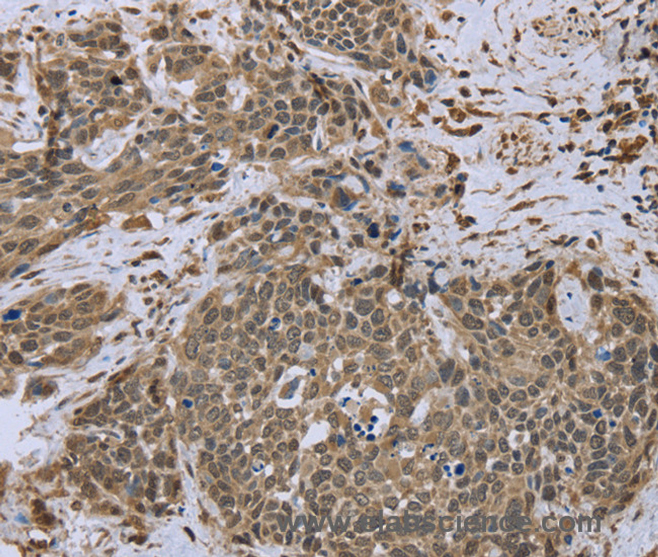 Immunohistochemistry of paraffin-embedded Human cervical cancer tissue using DCTN4 Polyclonal Antibody at dilution 1:50