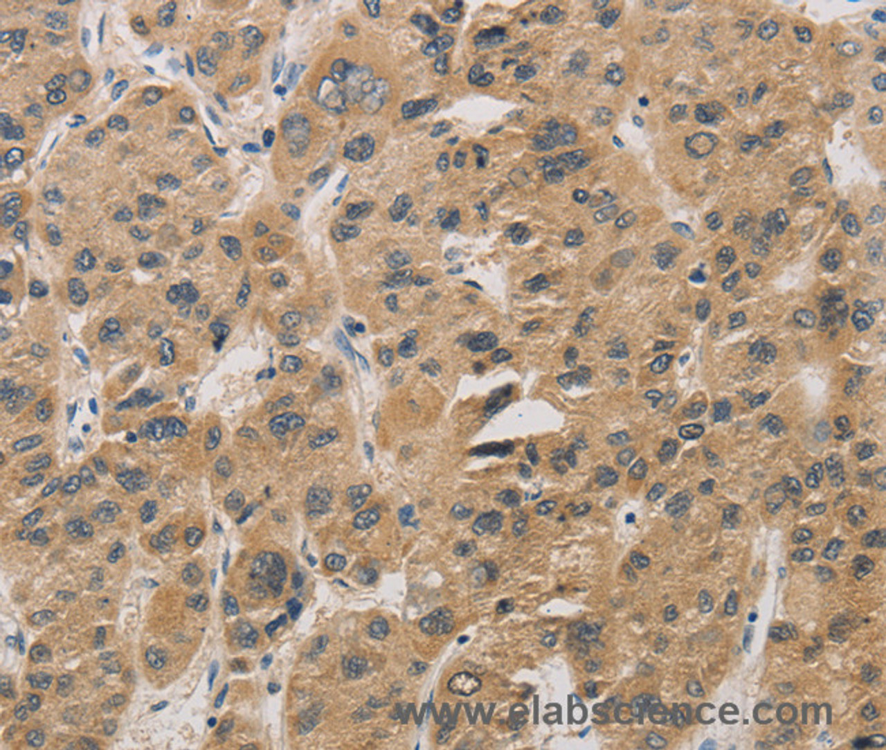 Immunohistochemistry of paraffin-embedded Human liver cancer tissue using DDIT4 Polyclonal Antibody at dilution 1:30
