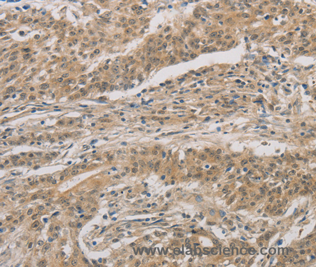 Immunohistochemistry of paraffin-embedded Human gastric cancer tissue using DDIT4 Polyclonal Antibody at dilution 1:30