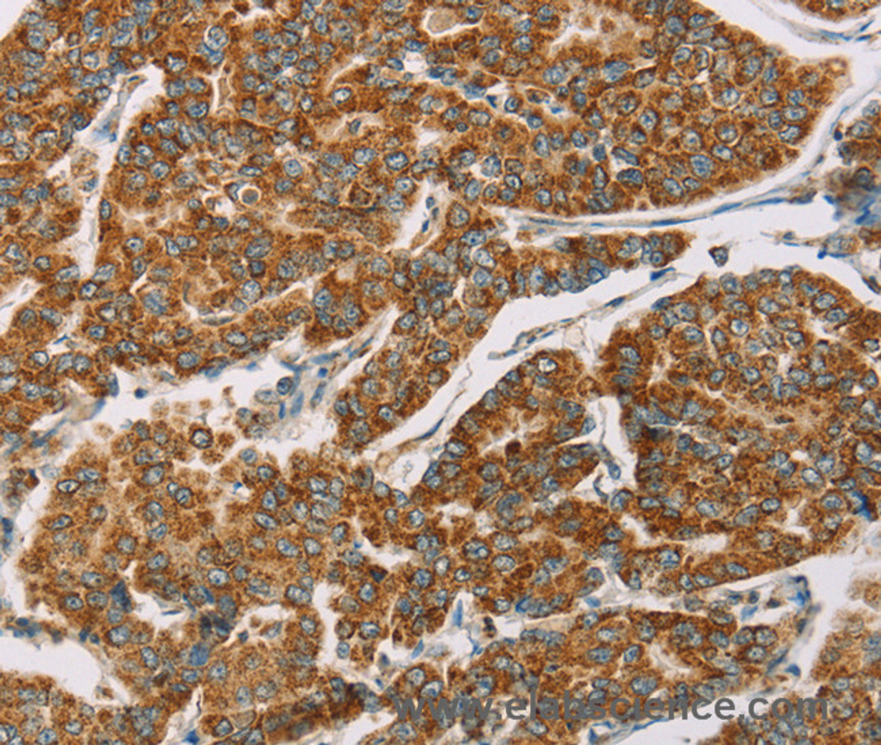 Immunohistochemistry of paraffin-embedded Human breast cancer tissue using DLL4 Polyclonal Antibody at dilution 1:40