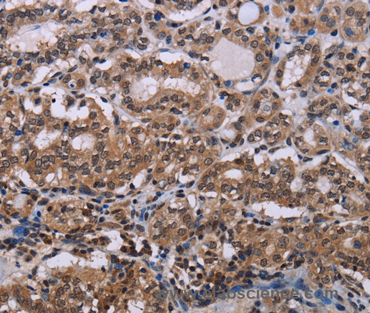 Immunohistochemistry of paraffin-embedded Human thyroid cancer tissue using DLX4 Polyclonal Antibody at dilution 1:50