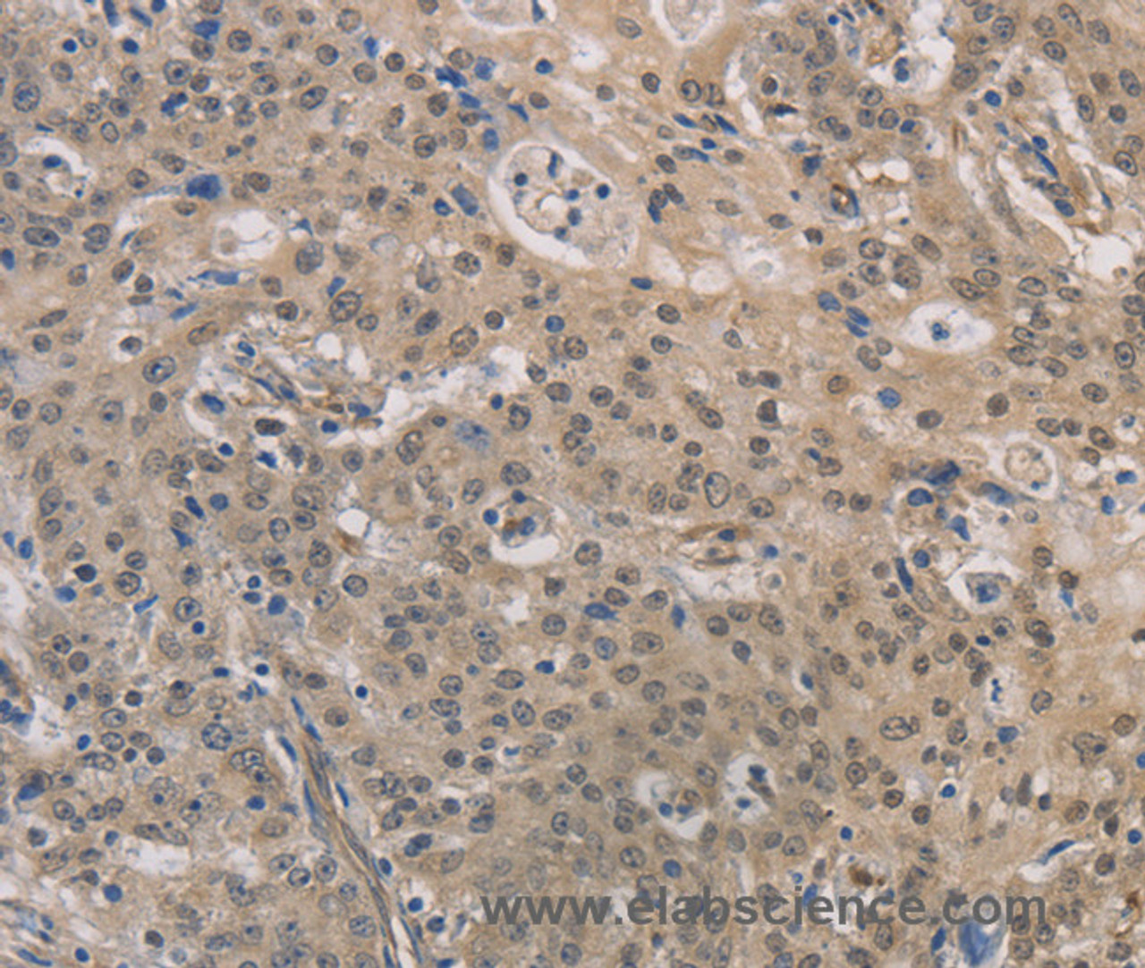 Immunohistochemistry of paraffin-embedded Human gastric cancer using DPYSL3 Polyclonal Antibody at dilution of 1:30