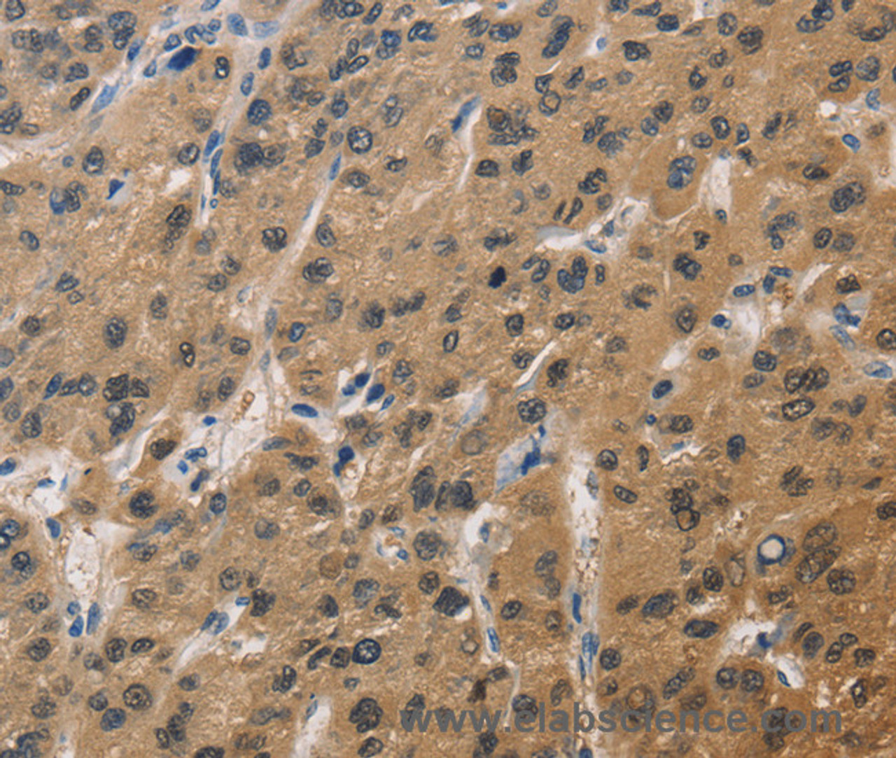 Immunohistochemistry of paraffin-embedded Human liver cancer tissue using DUSP26 Polyclonal Antibody at dilution 1:60