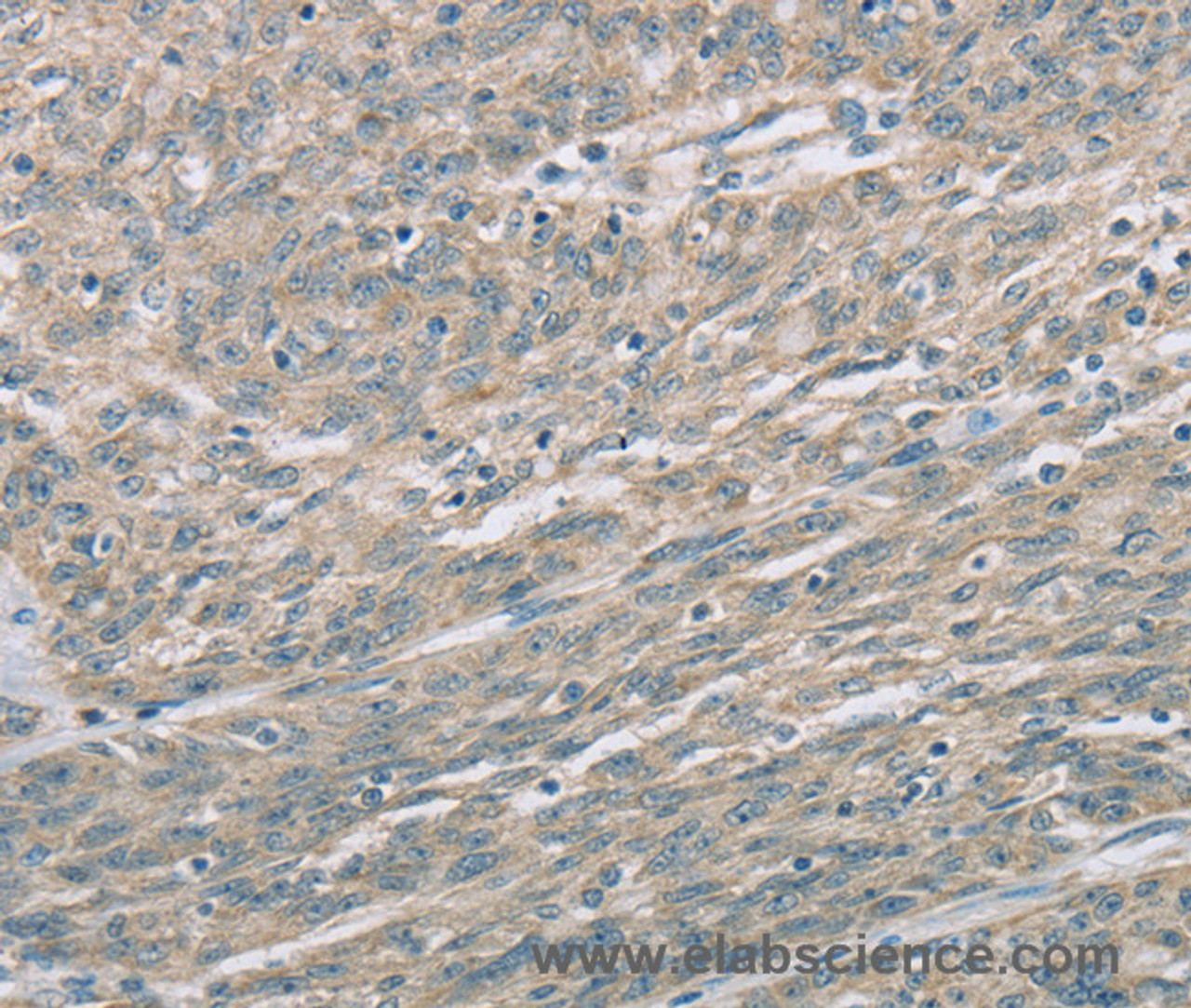 Immunohistochemistry of paraffin-embedded Human esophagus cancer using EDA2R Polyclonal Antibody at dilution of 1:60