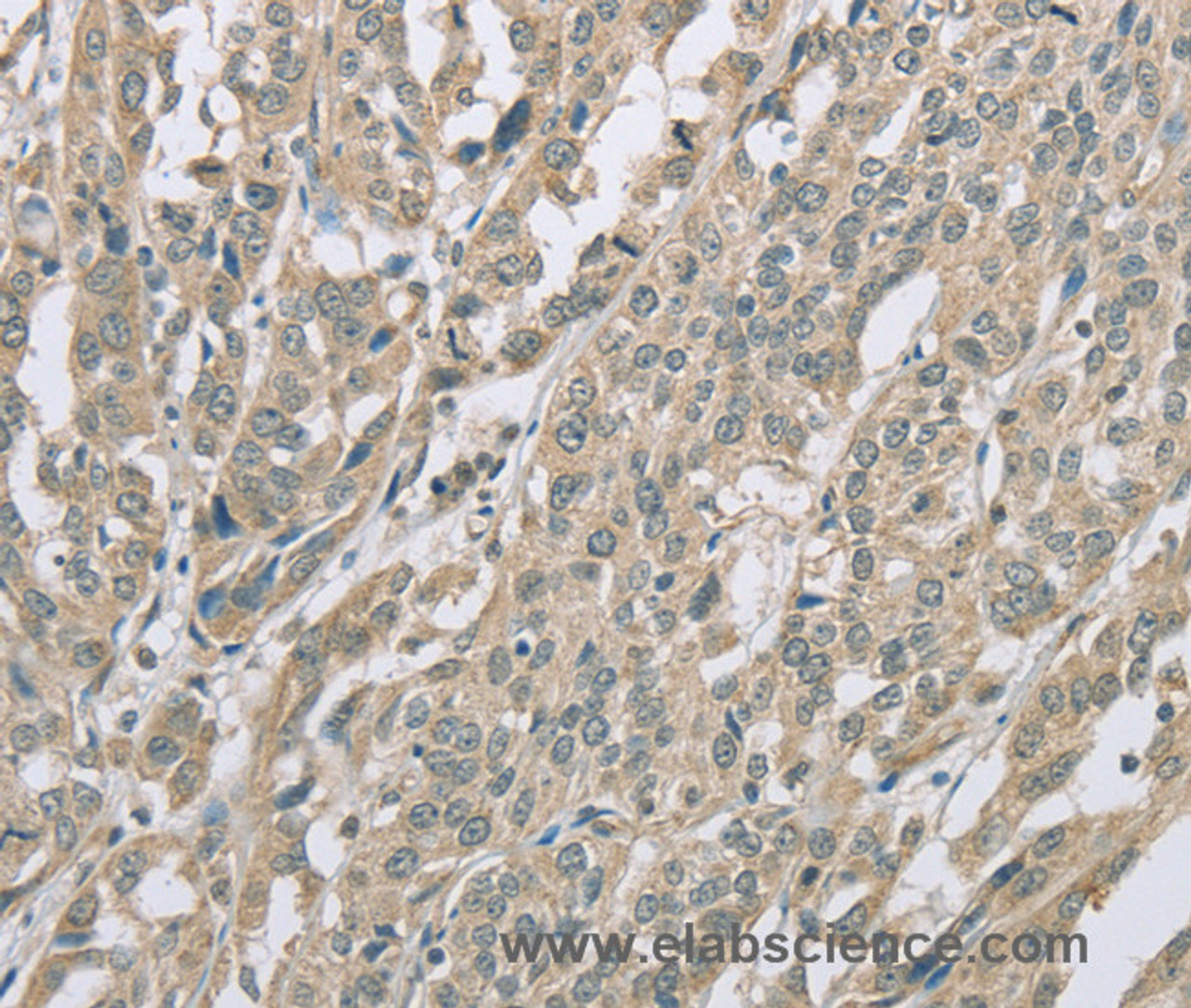 Immunohistochemistry of paraffin-embedded Human ovarian cancer using EDA2R Polyclonal Antibody at dilution of 1:60
