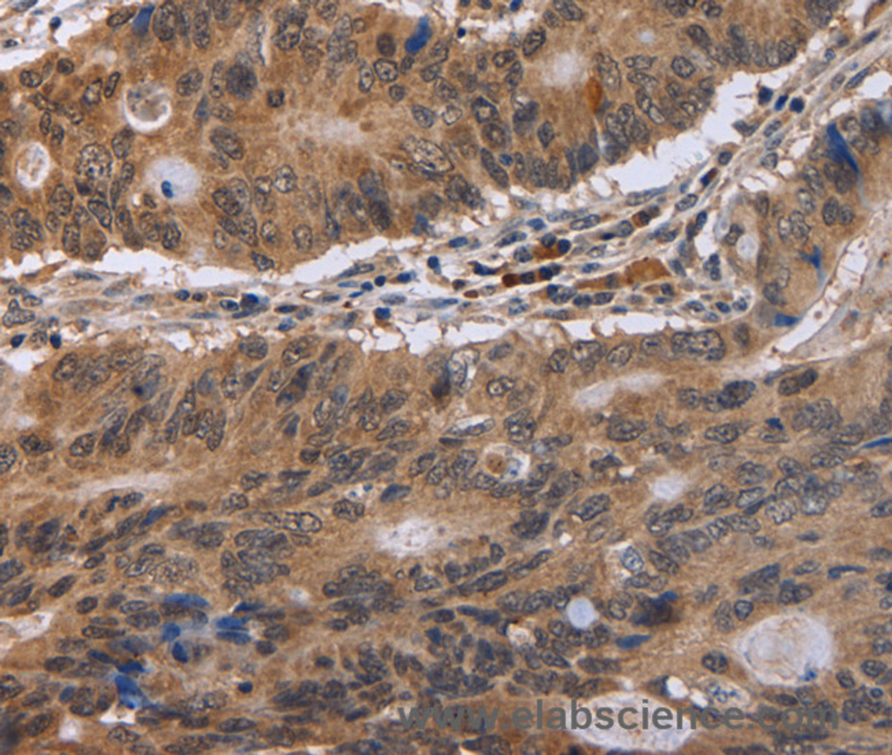 Immunohistochemistry of paraffin-embedded Human colon cancer tissue using EIF3H Polyclonal Antibody at dilution 1:40