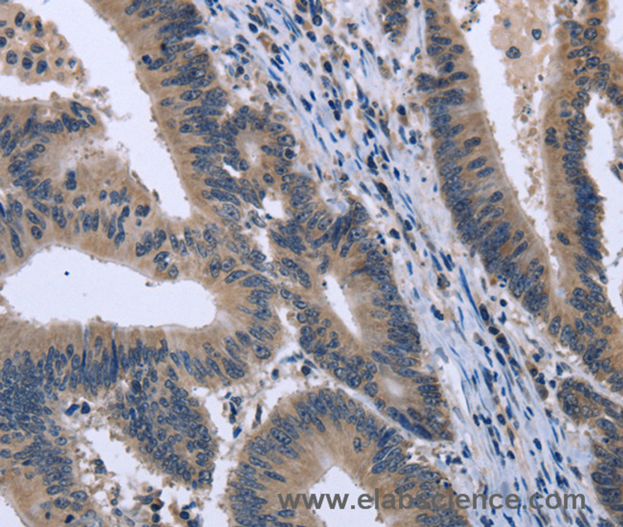 Immunohistochemistry of paraffin-embedded Human colon cancer tissue using KCNJ11 Polyclonal Antibody at dilution 1:40