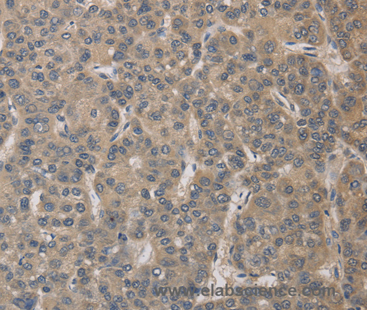 Immunohistochemistry of paraffin-embedded Human liver cancer tissue using ELOVL1 Polyclonal Antibody at dilution 1:30