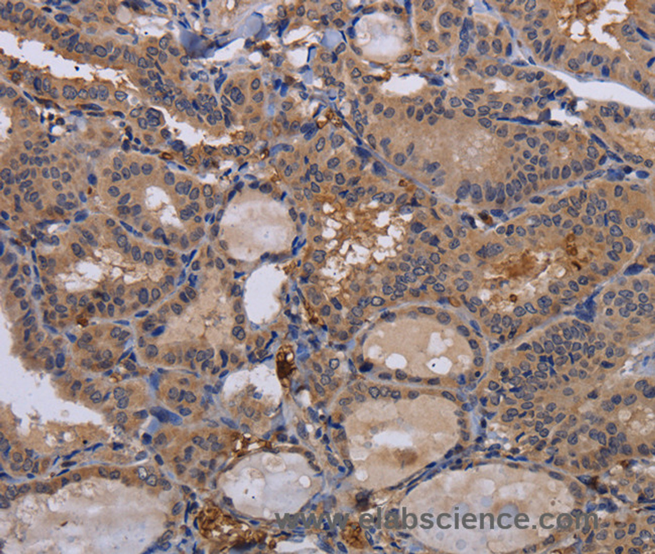 Immunohistochemistry of paraffin-embedded Human thyroid cancer using FADS1 Polyclonal Antibody at dilution of 1:60