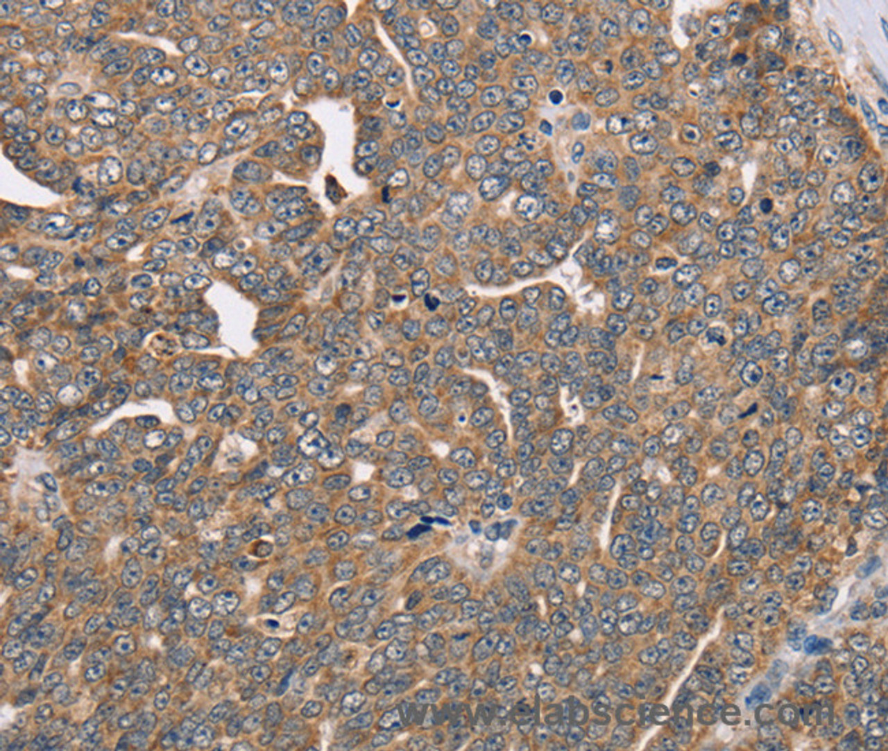 Immunohistochemistry of paraffin-embedded Human cervical cancer tissue using FAIM2 Polyclonal Antibody at dilution 1:40